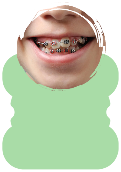 braces treatment