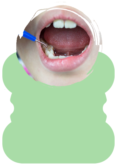 pit fissure sealant
